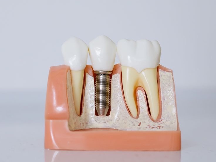 A vida antes e depois dos implantes dentários